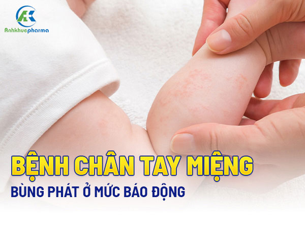 Bệnh tay chân miệng diễn biến đáng ngại: Nguyên nhân, diễn biến và cách điều trị Untitled 1