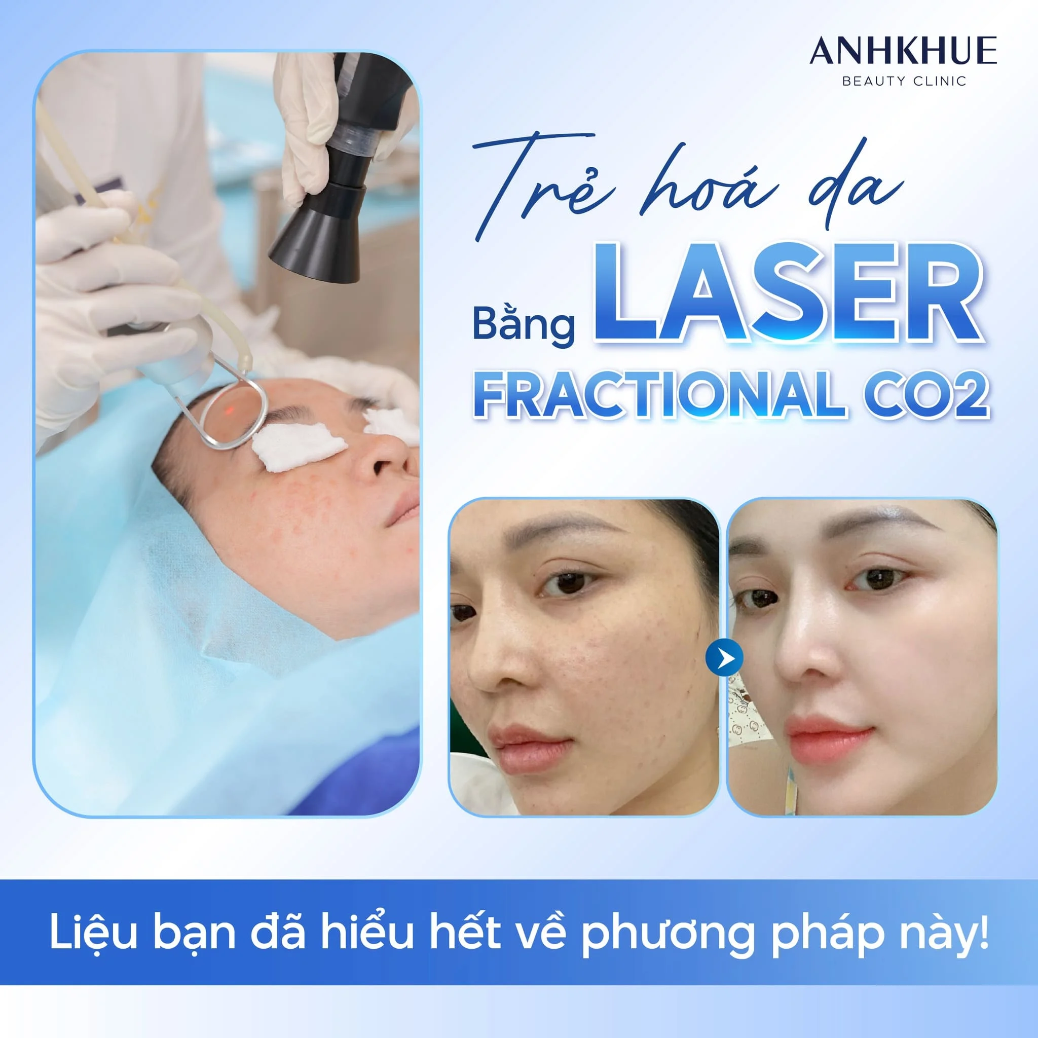 Laser CO2 Fractional – Công nghệ làm đẹp tiên tiến hiện nay