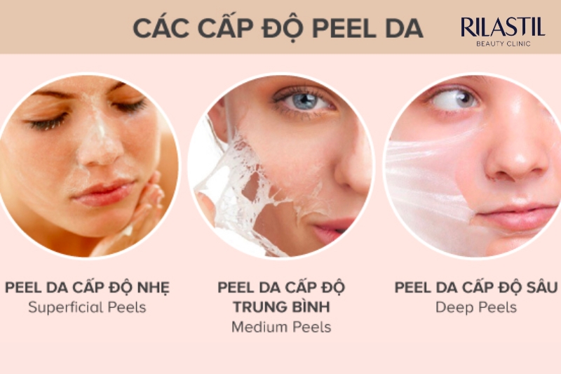 Peel da giúp giảm mụn đầu đen hiệu quả
