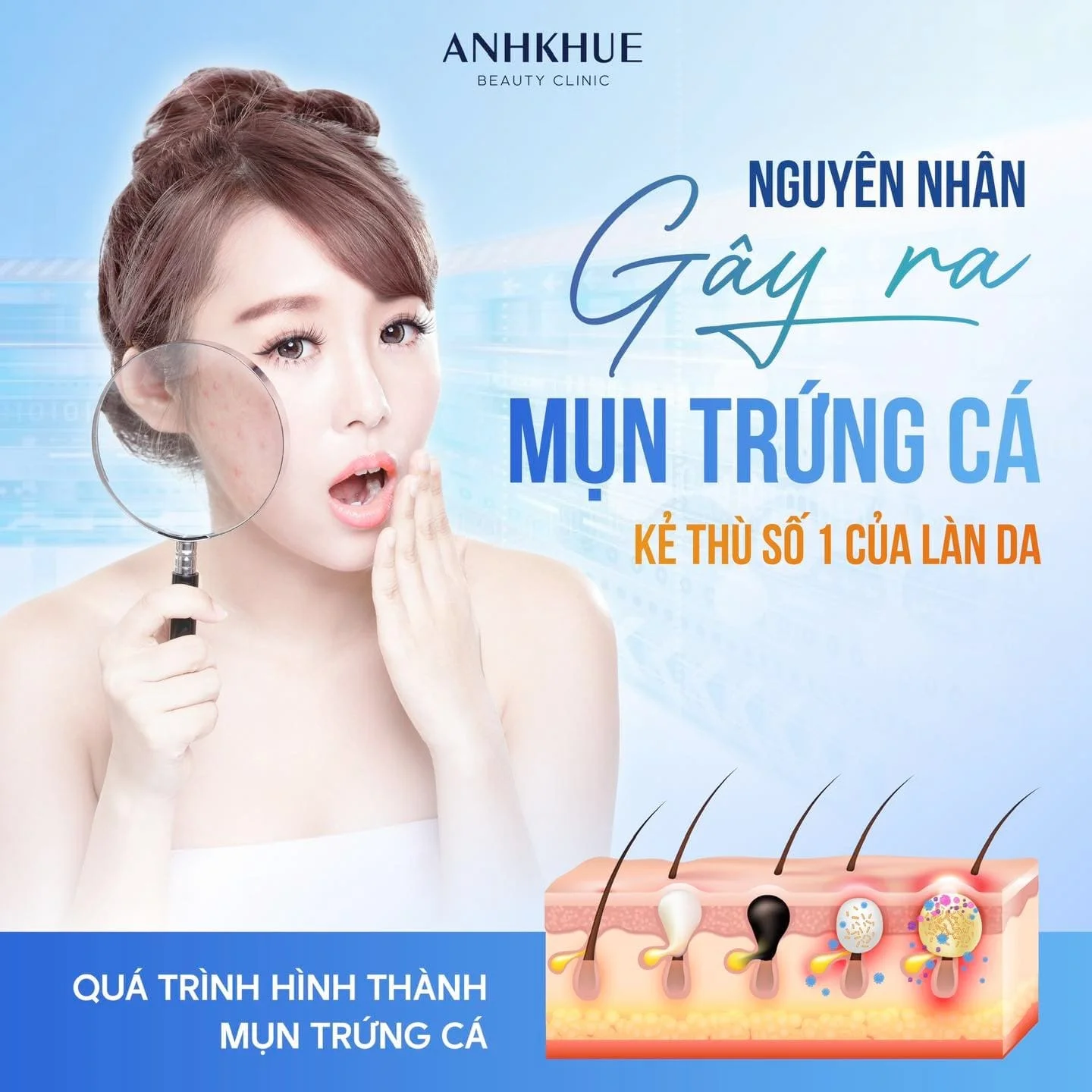 Mụn trứng cá: Nguyên nhân và cách điều trị hiệu quả