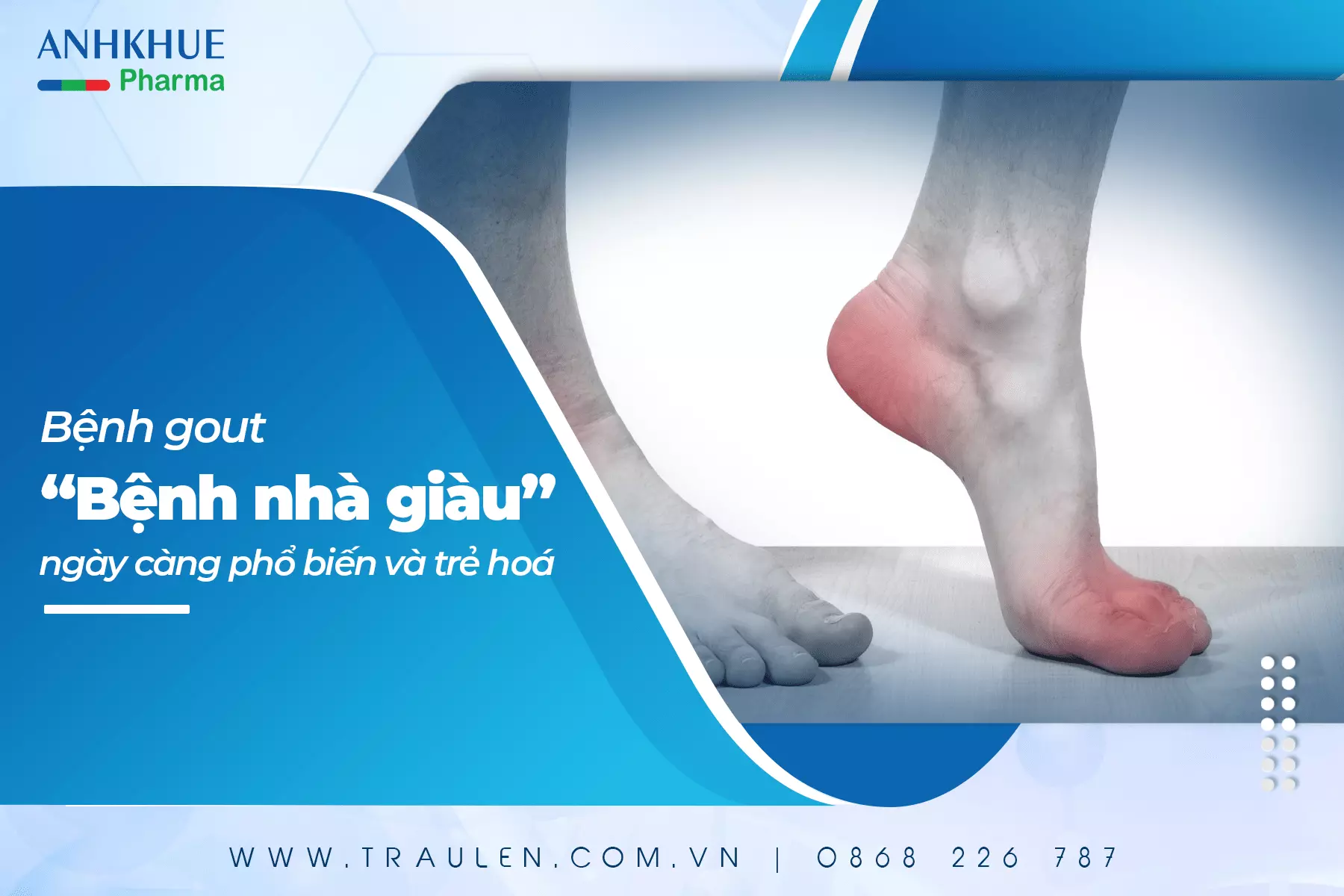 Bệnh gout - “Bệnh nhà giàu” đang ngày gia tăng và trẻ hoá benh gout banner