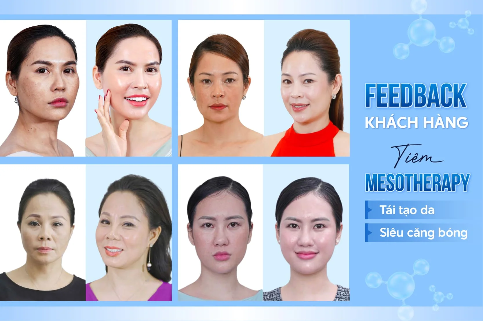 Hình ảnh khách hàng làm Mesotherapy trẻ hóa tại Anh Khuê Beauty Clinic