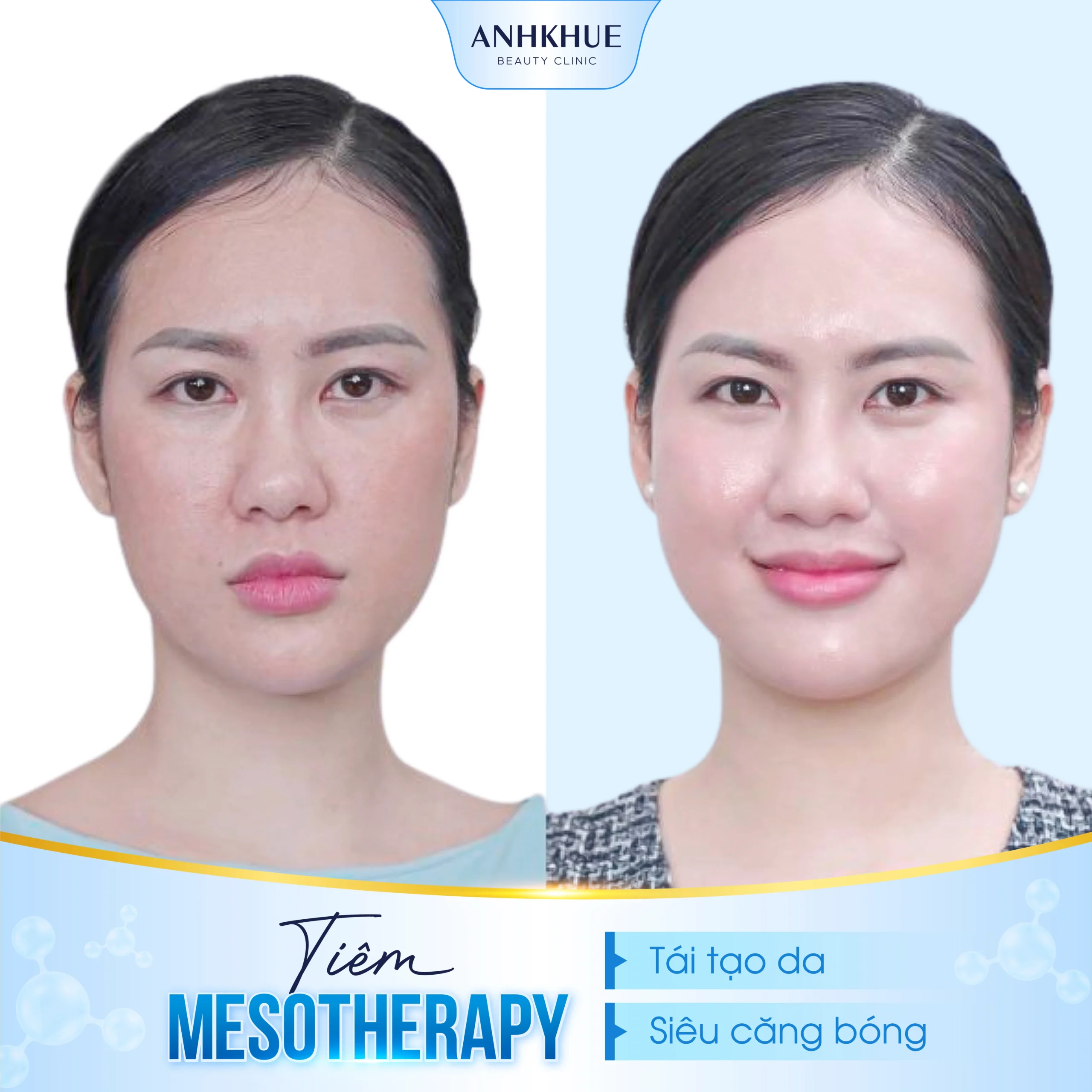 Trẻ hóa da mặt bằng Mesotherapy tại Anh Khuê Beauty Clinic