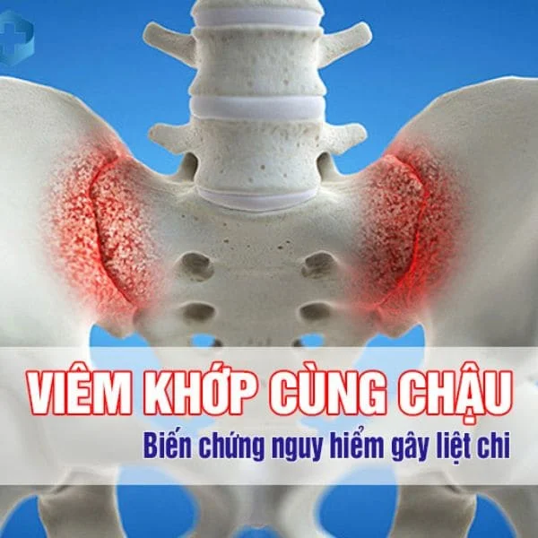 Viêm Khớp Cùng Chậu: Nguyên nhân, triệu chứng và cách phòng ngừa