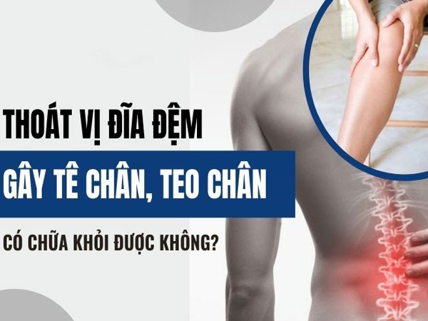 Thoát vị đĩa đệm gây teo chân có nguy hiểm không? Làm sao để phòng ngừa và điều trị? Untitled 1 2