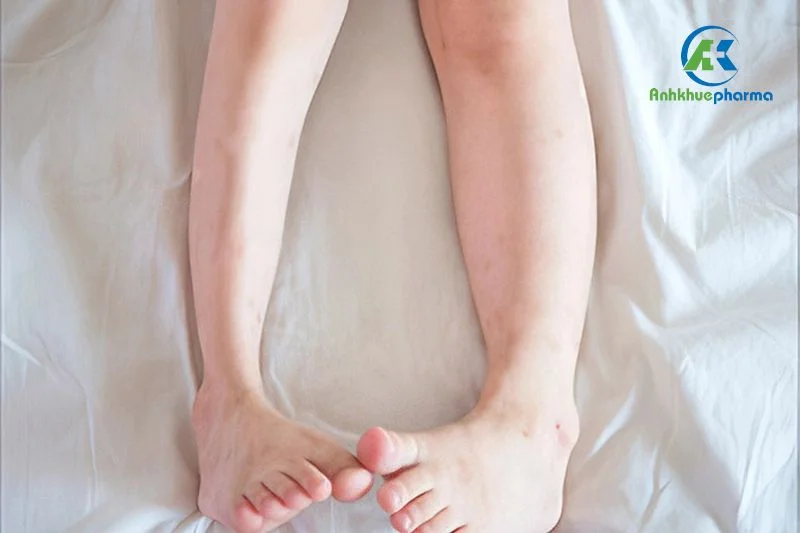 Để ngăn biến chứng teo chân, người bệnh cần điều trị sớm bệnh thoát vị đĩa đệm