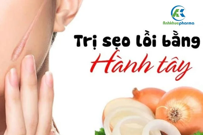 Hành tây ức chế tăng sinh melanin giúp vết sẹo lồi sáng màu hơn, thẩm mỹ hơn