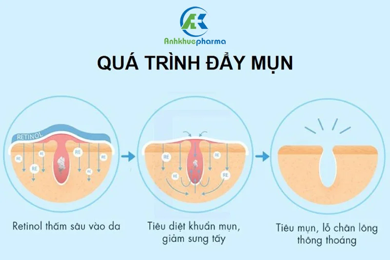 Đẩy mụn là hiện tượng thường thấy khi sử dụng các sản phẩm tẩy tế bào chết có AHA, BHA, retinoids...