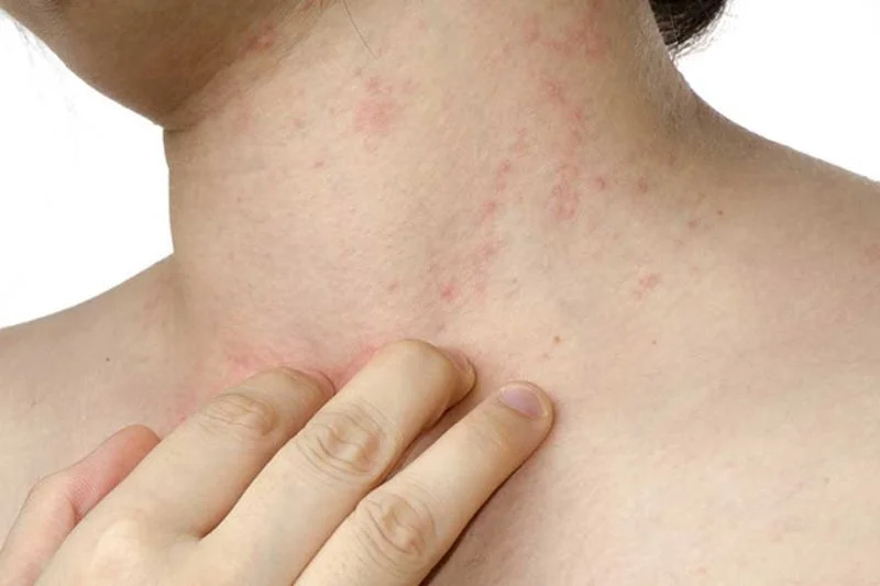 Nhiều người cảm thấy ngứa ngáy khó chịu, nhưng không thể gãi vì sợ làm vỡ mụn nước