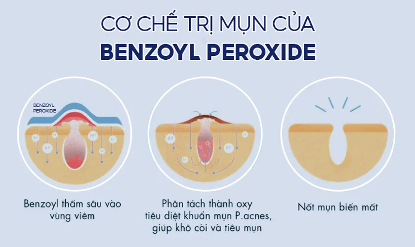 Benzoyl Peroxide có thể gây khô da, bong tróc và kích ứng, đặc biệt là với da nhạy cảm
