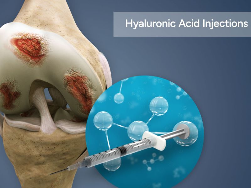 Vai trò của Glucosamine và các hoạt chất hỗ trợ trong điều trị thoái hóa khớp Sau khi được tiêm vào khớp, Acid Hyaluronic giúp ức chế thụ thể đau, giúp giảm đau và hạn chế sự phân hủy protein có vai trò duy trì cấu trúc sụn