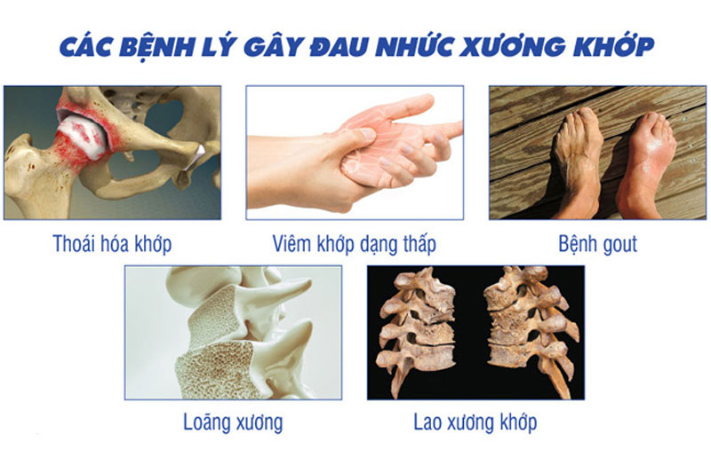Đau nhức xương khớp có thể là triệu chứng cảnh báo những bệnh lý xương khớp nguy hiểm
