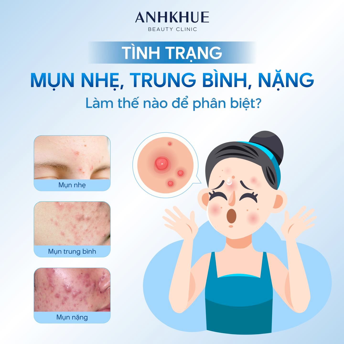 Purging khi dùng Adapalene: Hiện tượng bình thường hay dấu hiệu cần lo lắng? bung mun