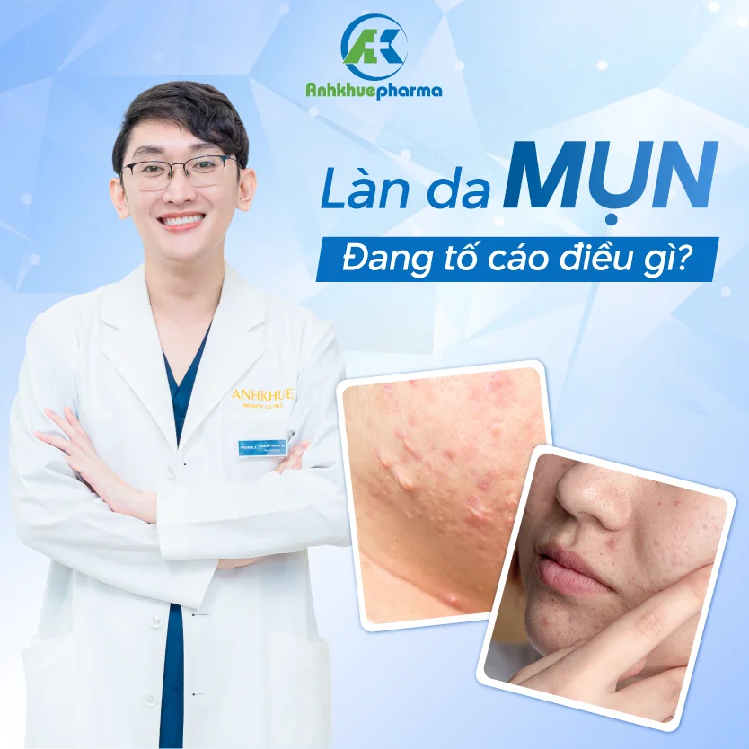 Những điều da mụn chưa nói với bạn