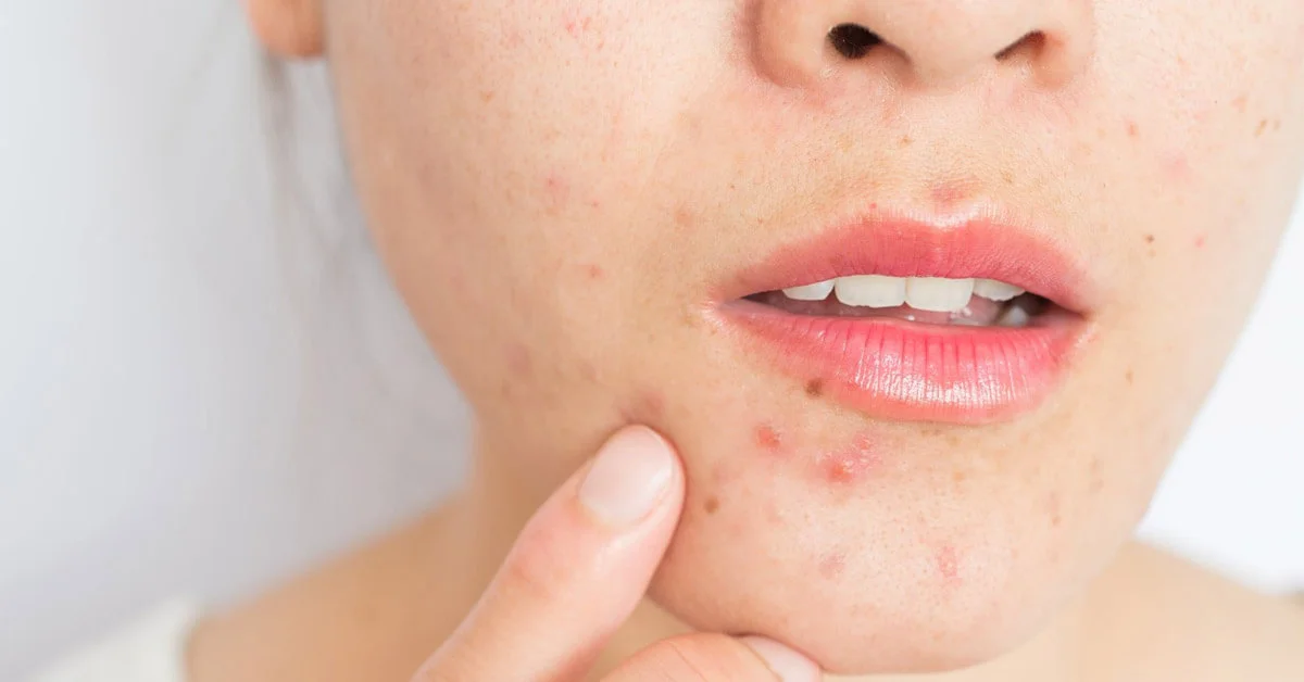Nổi mụn là cách thông báo làn da đang có sự xâm lấn của vi khuẩn, sự viêm nhiễm