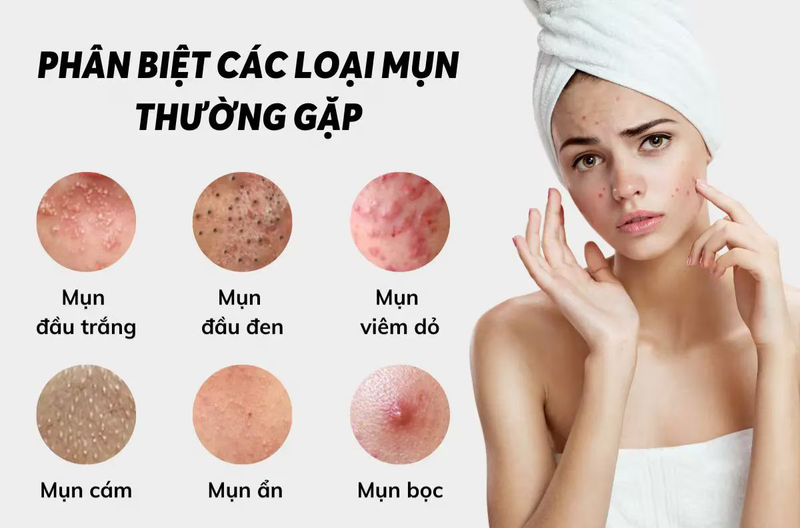 Việc hiểu rõ từng loại mụn sẽ giúp lựa chọn phương pháp vệ sinh và chăm sóc da phù hợp để cải thiện làn da hiệu quả