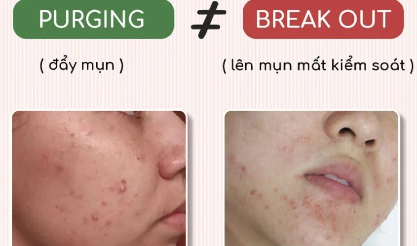 Mụn kích ứng và mụn dị ứng khác nhau hoàn toàn về cơ chế hình thành, biểu hiện, thời gian xuất hiện, nguyên nhân và hướng xử lý