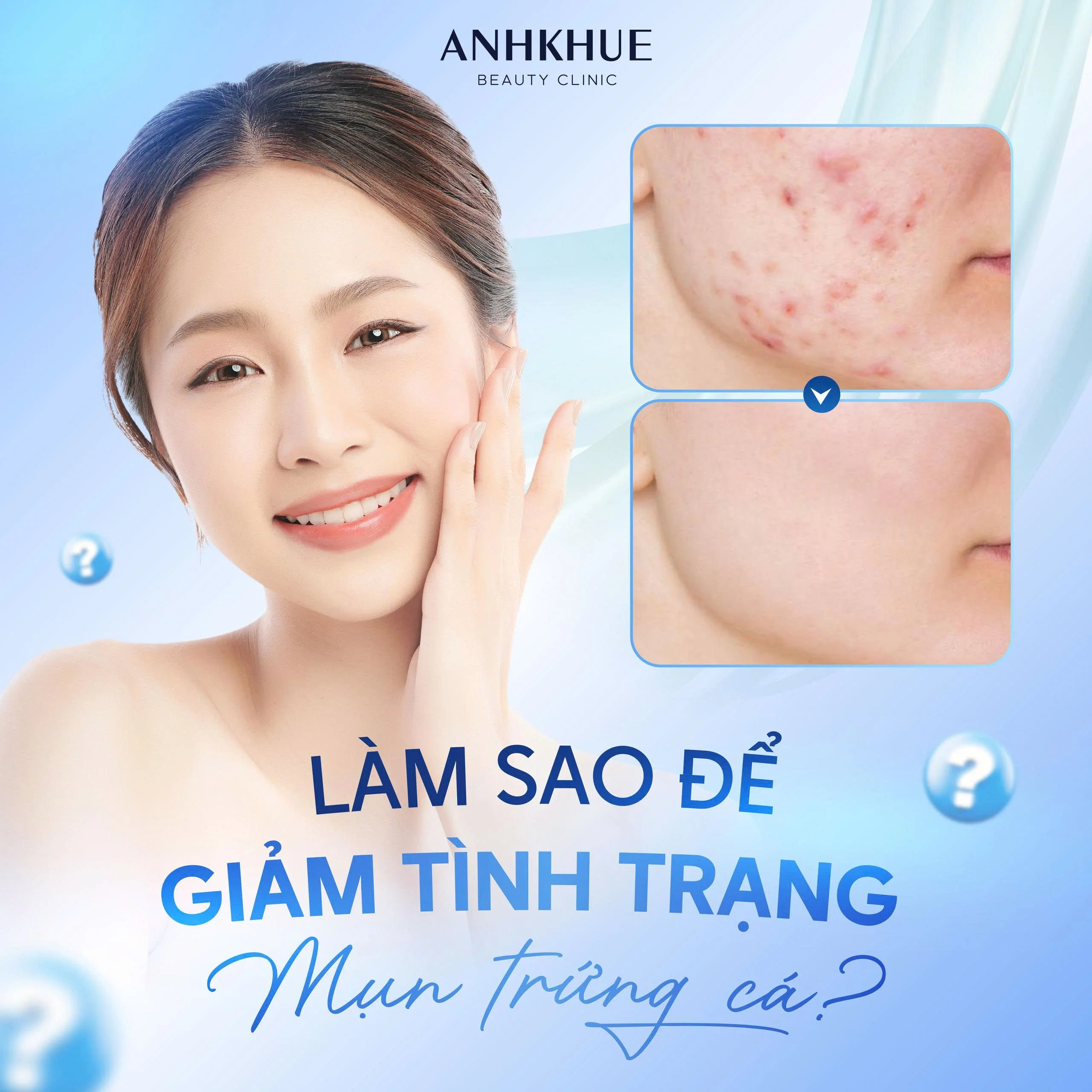 Chỉ 10 phút mỗi ngày, tạm biệt mụn trứng cá nhờ các hoạt chất trị mụn tối ưu