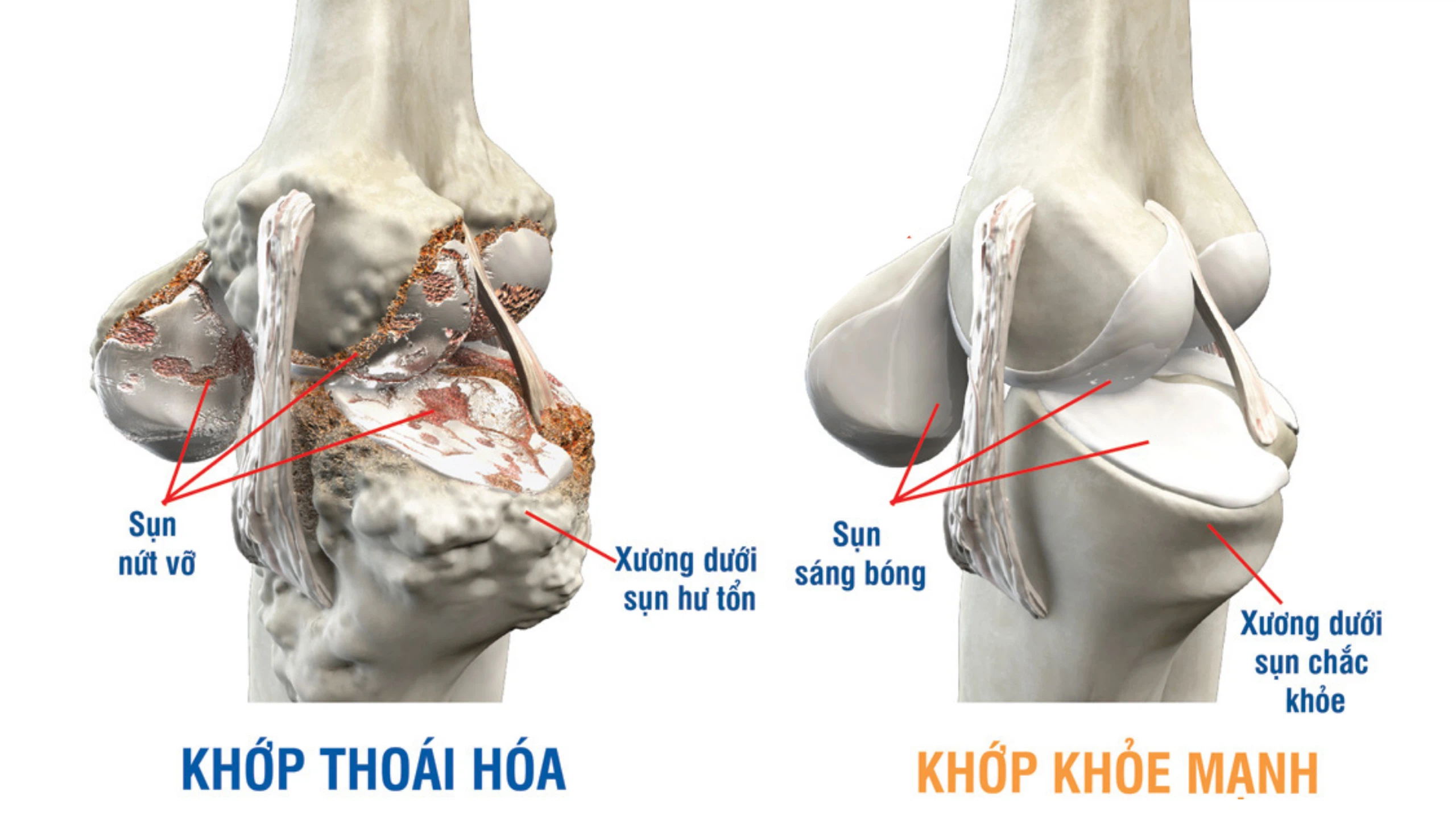 Vai trò của Glucosamine và các hoạt chất hỗ trợ trong điều trị thoái hóa khớp Thoái hóa khớp là một tình trạng viêm khớp thường gặp, nổi bật bởi sự suy giảm của lớp sụn