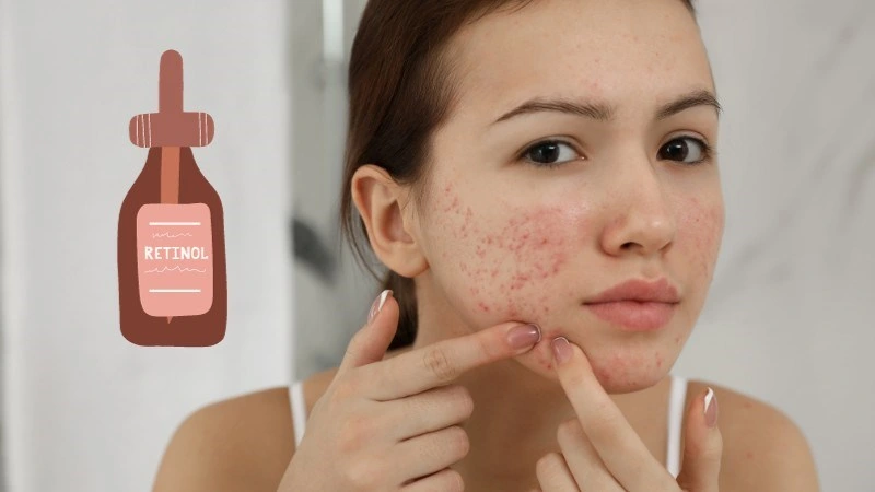 Retinol làm thông thoáng lỗ chân lông, ngăn ngừa tích tụ bụi bẩn, giúp giảm mụn và ngăn ngừa mụn mới