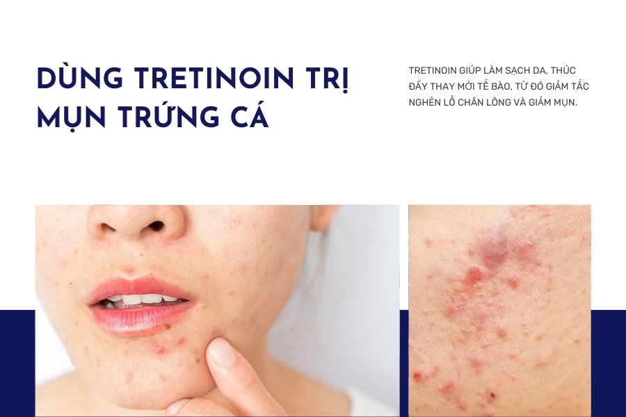 Tretinoin giúp giảm sự phát triển của microcomedones, thông thoáng lỗ chân lông và kiểm soát dầu thừa trên da, từ đó ngăn chặn mụn mới và giảm vi khuẩn gây mụn