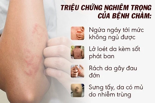 Bệnh chàm (Eczema): Dấu hiệu, nguyên nhân, biến chứng và chẩn đoán Bệnh chàm là bệnh lý da mạn tính rất phổ biến, tiến triển từng đợt hay tái phát, đặc trưng là những mảng da đỏ, mụn nước, bong vảy, ngứa