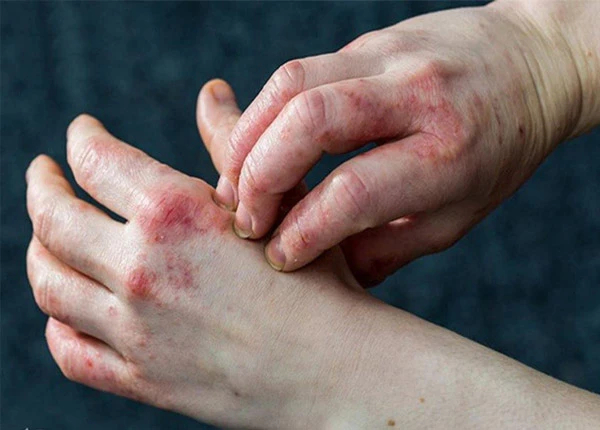 Bệnh chàm (Eczema): Dấu hiệu, nguyên nhân, biến chứng và chẩn đoán Bệnh chàm (eczema) là tình trạng viêm da mãn tính, không lây, đặc trưng bởi các mảng da đỏ, khô, ngứa dữ dội và có thể xuất hiện mụn nước