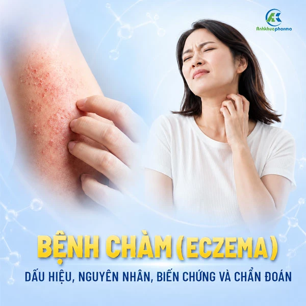 Bệnh chàm (Eczema): Dấu hiệu, nguyên nhân, biến chứng và chẩn đoán Bệnh chàm (Eczema): Dấu hiệu, nguyên nhân, biến chứng và chẩn đoán benh cham eczema