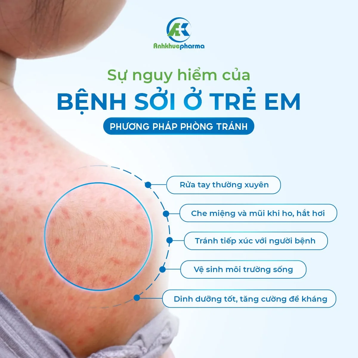 5 cách phòng ngừa bệnh sởi ở trẻ em nên biết sớm tránh nguy hiểm 5 cách phòng ngừa bệnh sởi ở trẻ em nên biết sớm tránh nguy hiểm benh soi tre em 1 1