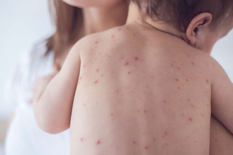 Bệnh sởi ở trẻ em: Dấu hiệu nhận biết và các phương pháp phòng ngừa Phát ban do sởi gây ra biến mất dần theo thứ tự đầu, mặt, cổ, tay, ngực, bụng, lưng, đùi, mông, chân…