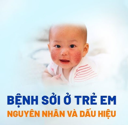 Bệnh sởi ở trẻ em: Dấu hiệu nhận biết và các phương pháp phòng ngừa Bệnh sởi ở trẻ em: Dấu hiệu nhận biết và các phương pháp phòng ngừa benh soi tre em 3
