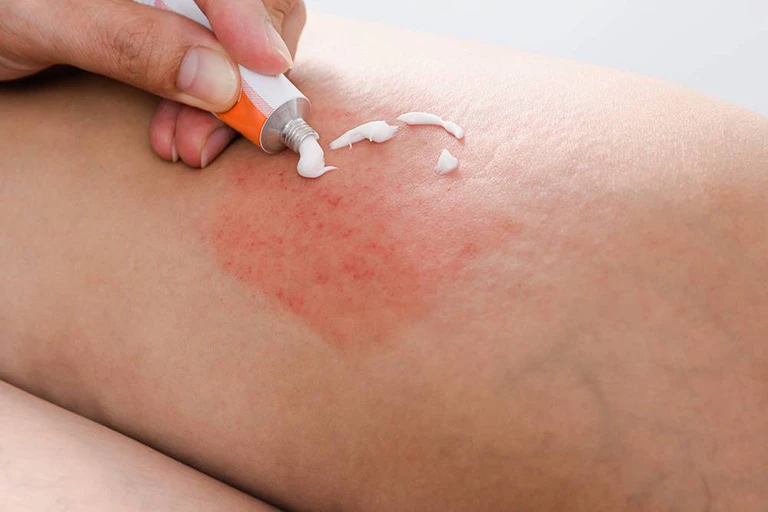 Bệnh chàm (Eczema): Dấu hiệu, nguyên nhân, biến chứng và chẩn đoán Các loại thuốc mỡ, kem dưỡng ẩm giúp chống khô da, hạn chế tình trạng bong tróc da, cấp ẩm cần thiết cho da
