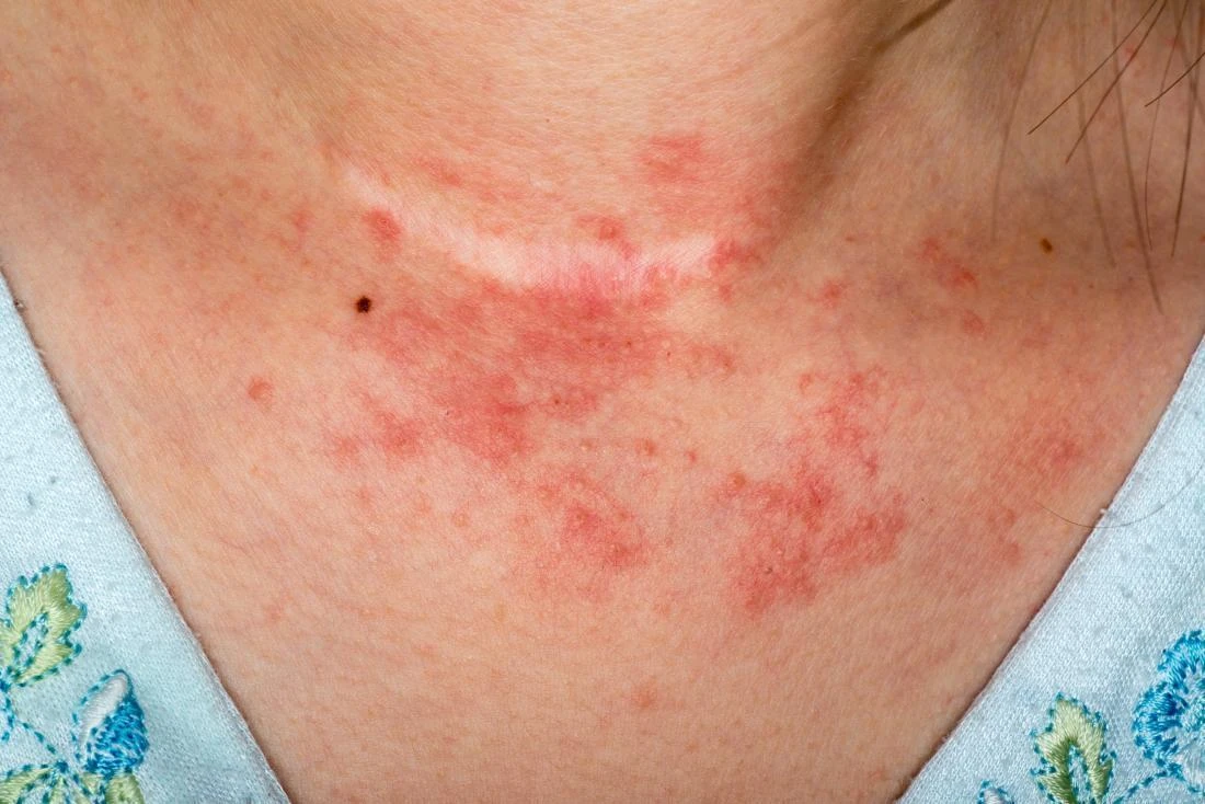 Bệnh chàm (Eczema): Dấu hiệu, nguyên nhân, biến chứng và chẩn đoán Viêm da tiếp xúc là tình trạng phát ban đỏ, ngứa do tiếp xúc trực tiếp với một chất gây kích ứng