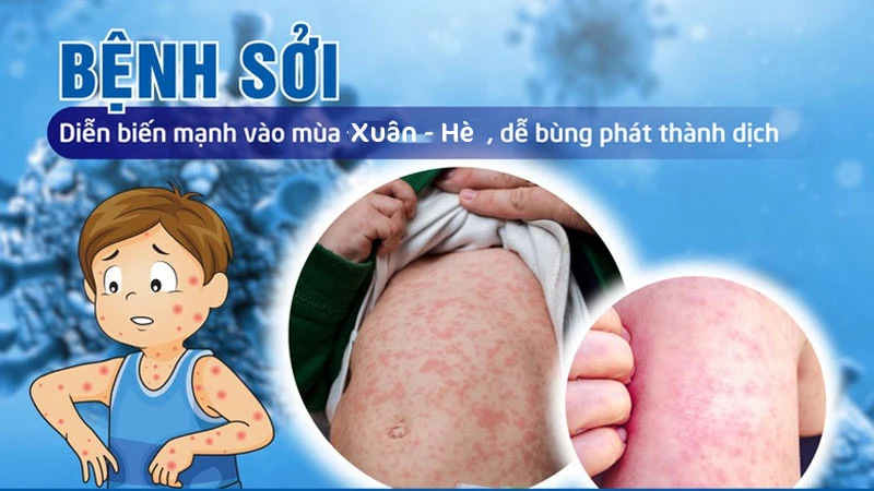 Tuyệt đối không chủ quan với 5 bệnh truyền nhiễm khó lường này trong mùa hè 2026 Giao mùa là điều kiện thuận lợi cho vi khuẩn, virus gây bệnh phát triển, làm dịch bệnh có thể bùng phát, lây lan trong cộng đồng, trong đó có bệnh sởi