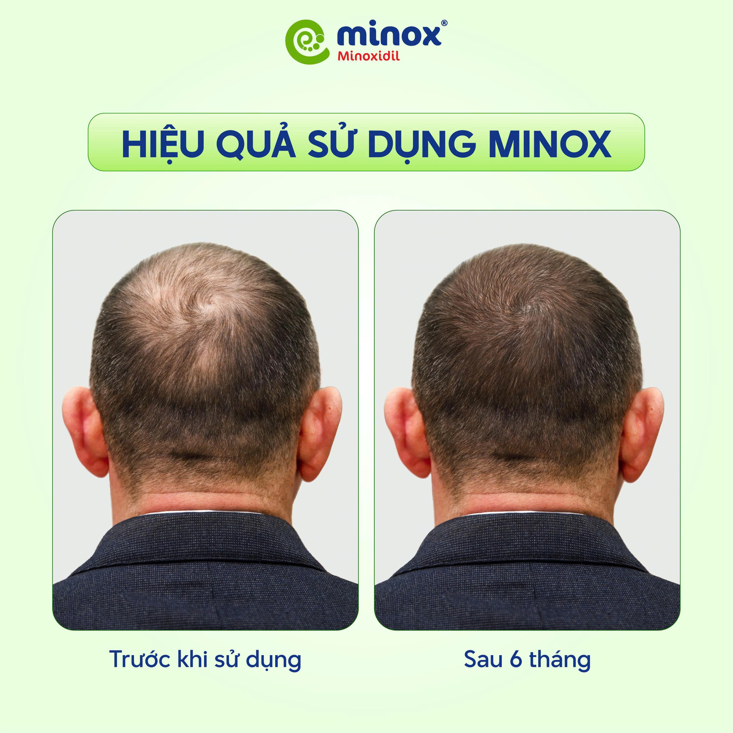 Mừng hè sang, săn deal rộn ràng cùng Minox Minox là một sản phẩm chuyên điều trị rụng tóc với thành phần chính là Minoxidil và Acid Salicylic